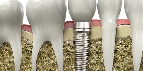 A 3D illustration of how dental implants embed into the jawbone
