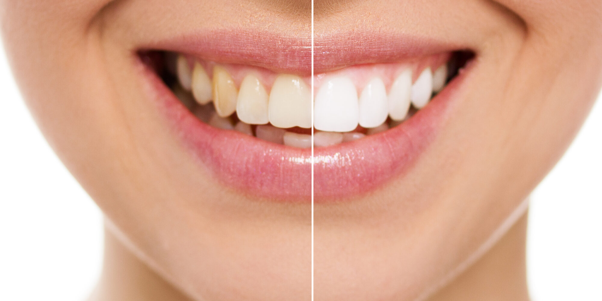 Teeth Whitening with Opalescence - Smile Care Dental Center