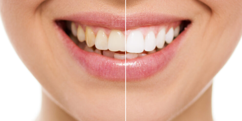 woman with teeth whitening treatment