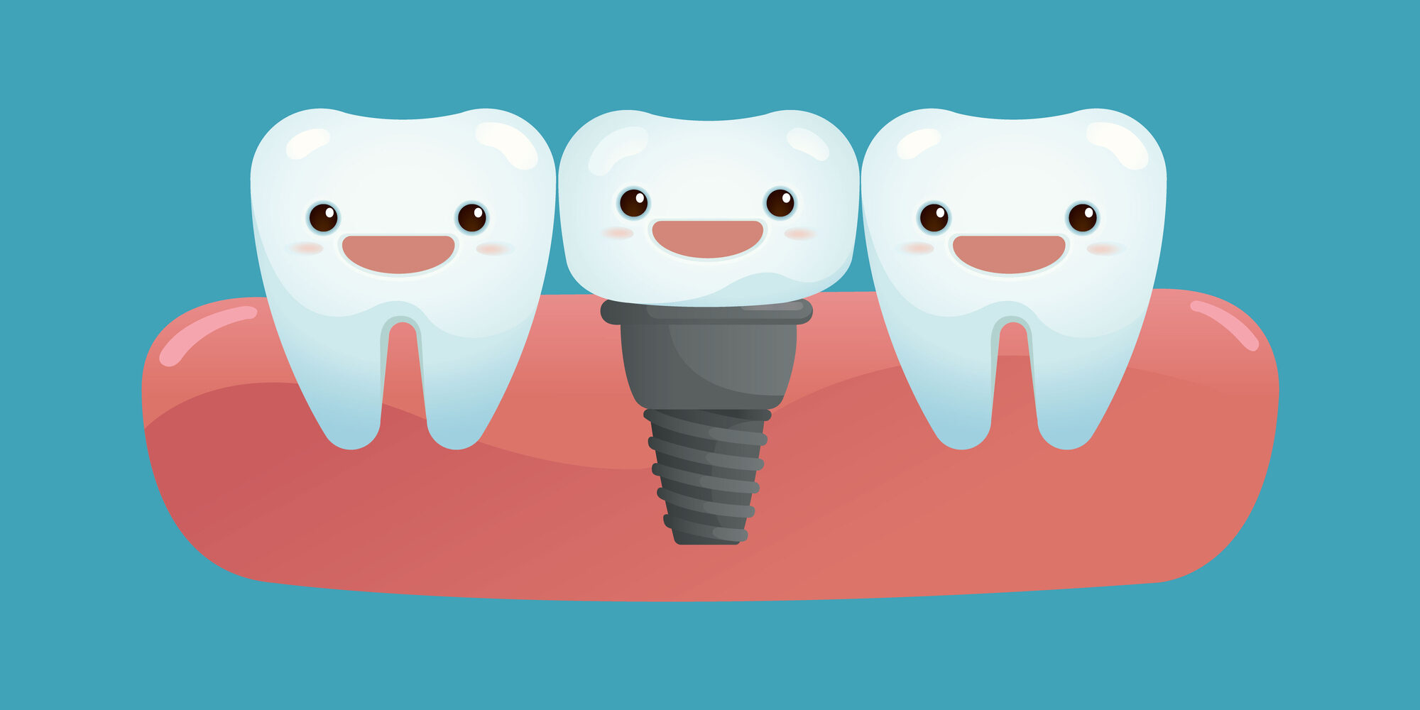 Top 5 Questions About Dental Implants - Chisholm Trail