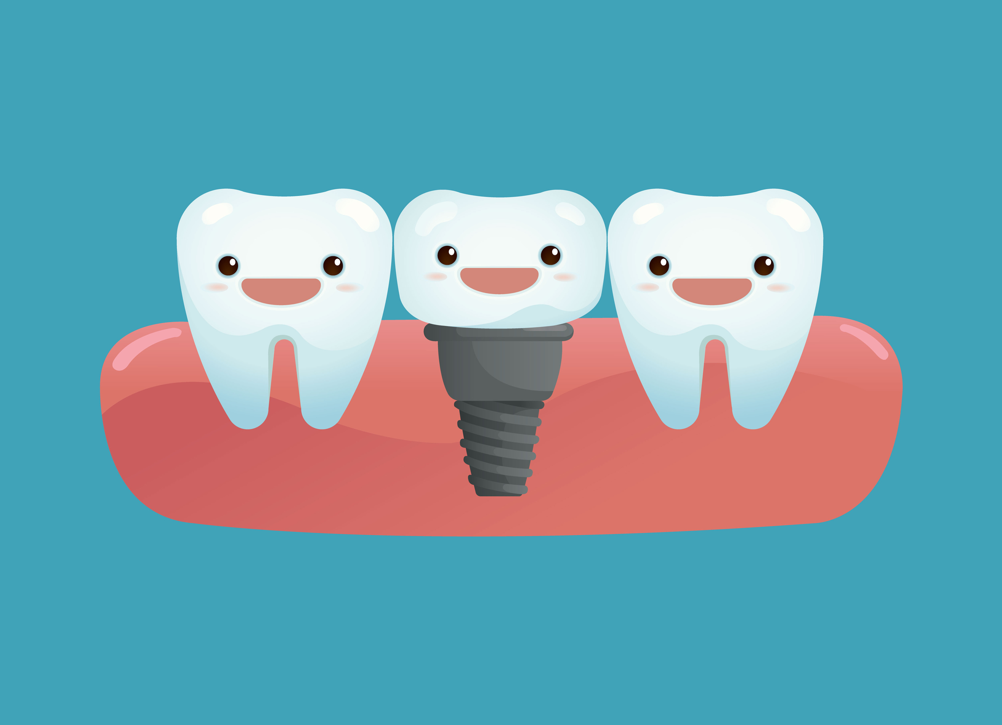 Top 5 Questions About Dental Implants - Chisholm Trail