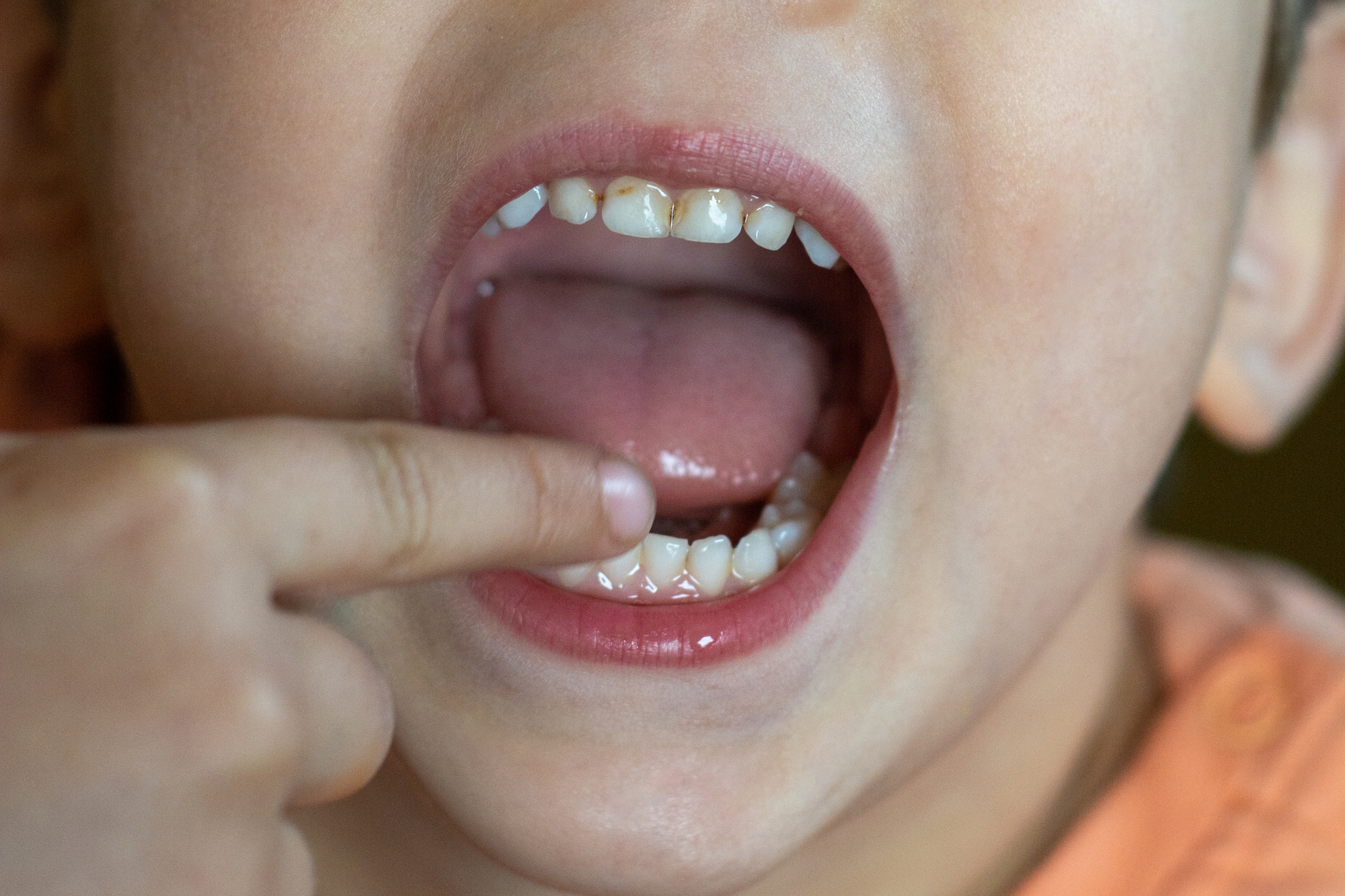 Kids' Dentist Answers: What is Baby Bottle Tooth Decay? - Smiles Dentistry  4 Kids