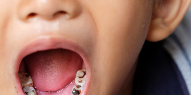 Little boy reveals cavities in his mouth