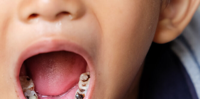 Little boy reveals cavities in his mouth