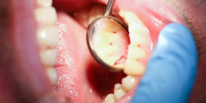 deep cleaning dentist looking at bleeding gums