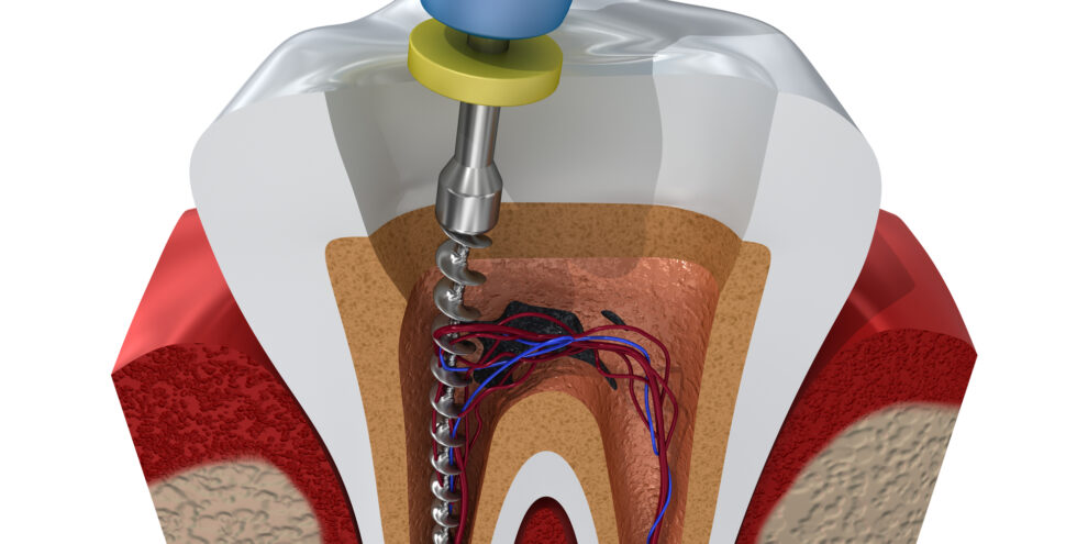 A 3D illustration indicating how dentist perform root canals