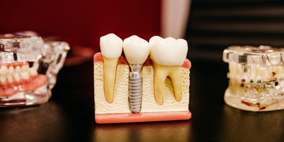 A small model showing where an implant dentist would place a dental implant into the jawbone
