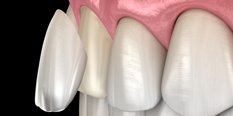A 3D rendering of how a Duncan, OK, dentist applies veneers to the teeth