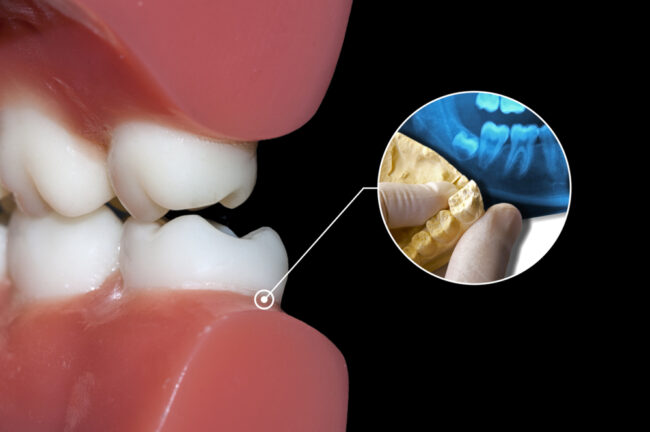toothache cause impacted wisdom tooth