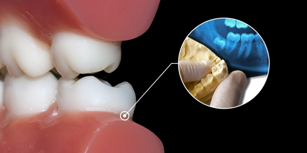 toothache cause impacted wisdom tooth