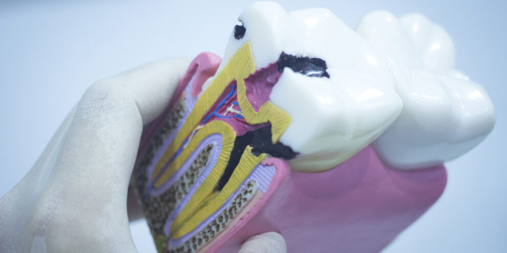 model showing cavities in molar