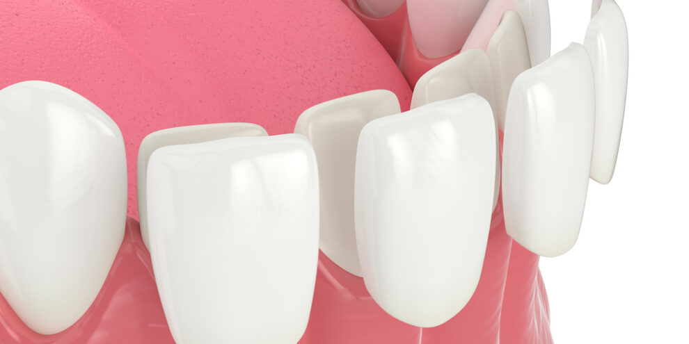 Illustration of four porcelain veneers goin on front, lower teeth
