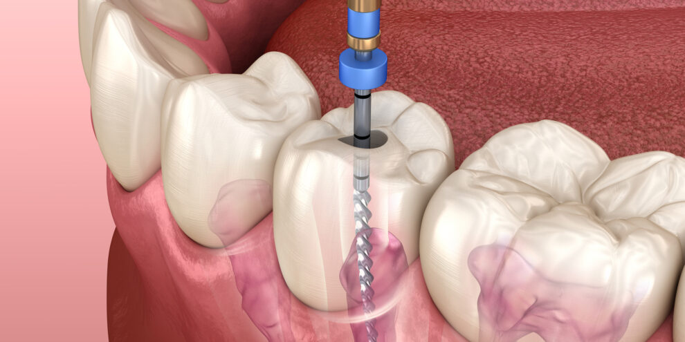 Endodontic root canal treatment process. Medically accurate tooth 3D illustration.