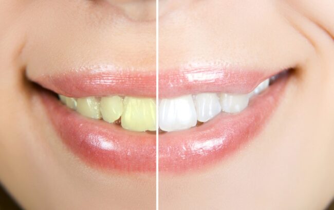Before and after cosmetic dentistry in duncan ok