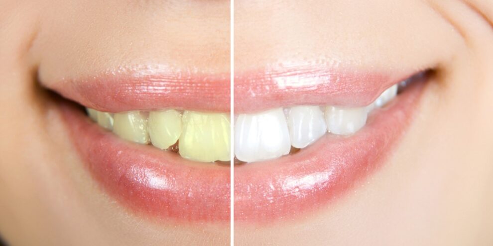 Before and after cosmetic dentistry in duncan ok