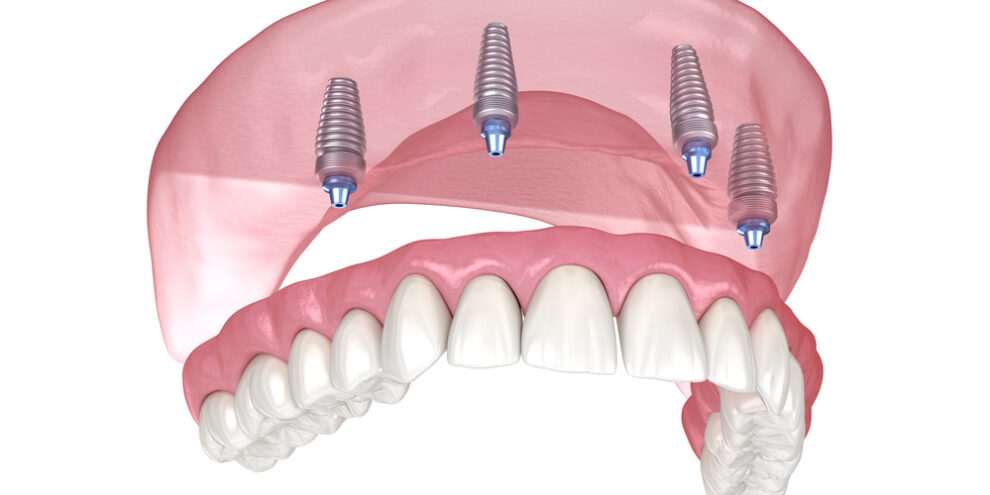 illustration of all on four implant with dentures