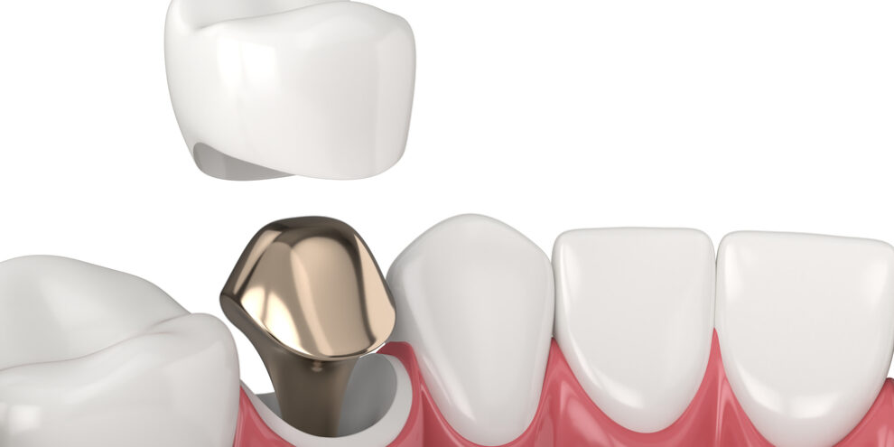 dental crown with implant