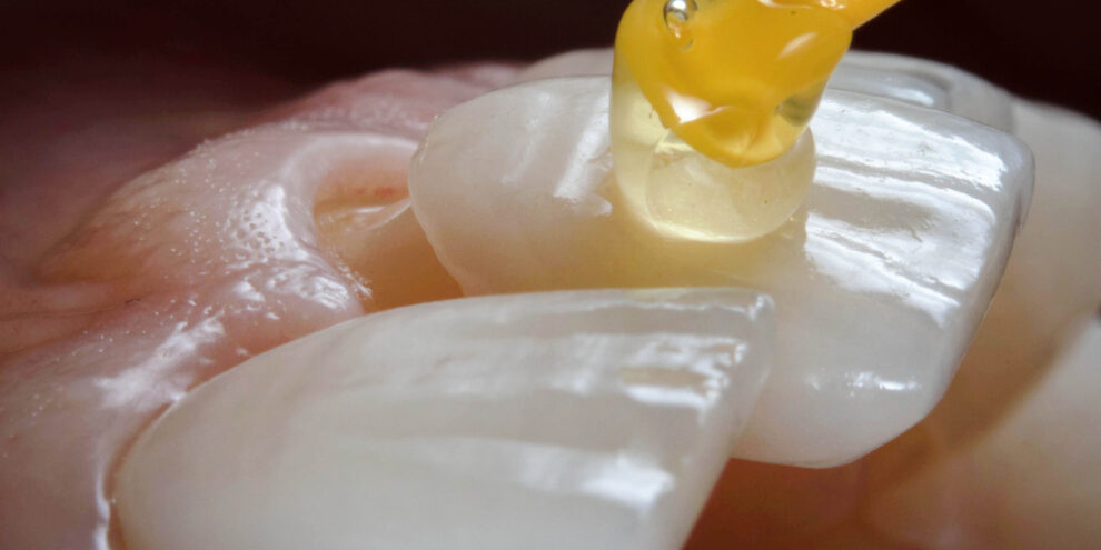 placing dental veneer to create normal teeth shape