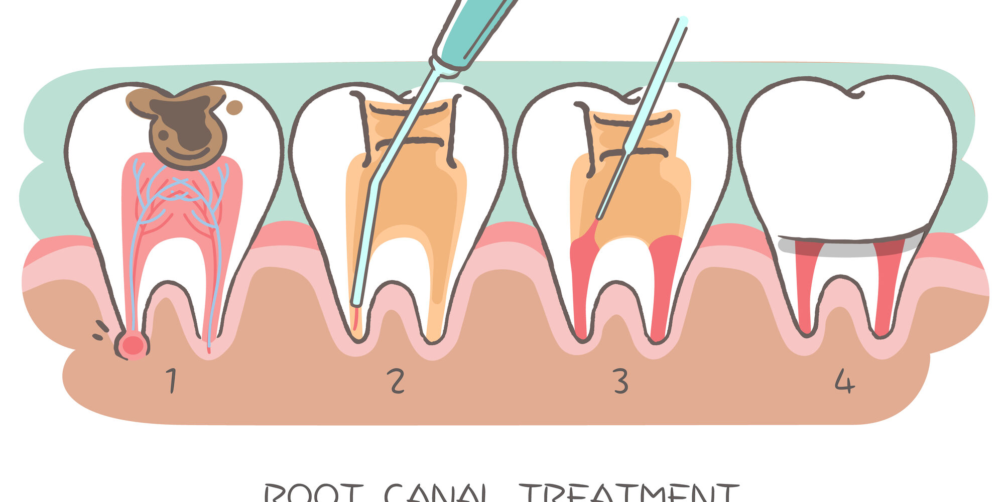 root canals treatment diagram