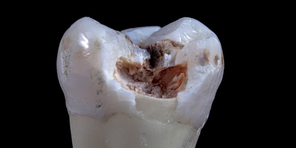 tooth with cavities on black background