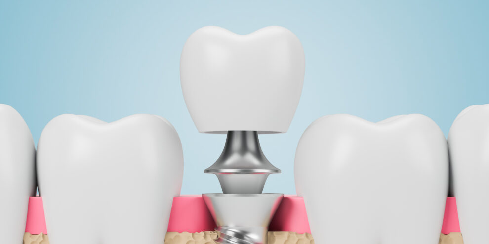 Row of teeth with dental implants screw over blue background. Concept of dental hygiene and care. 3d rendering