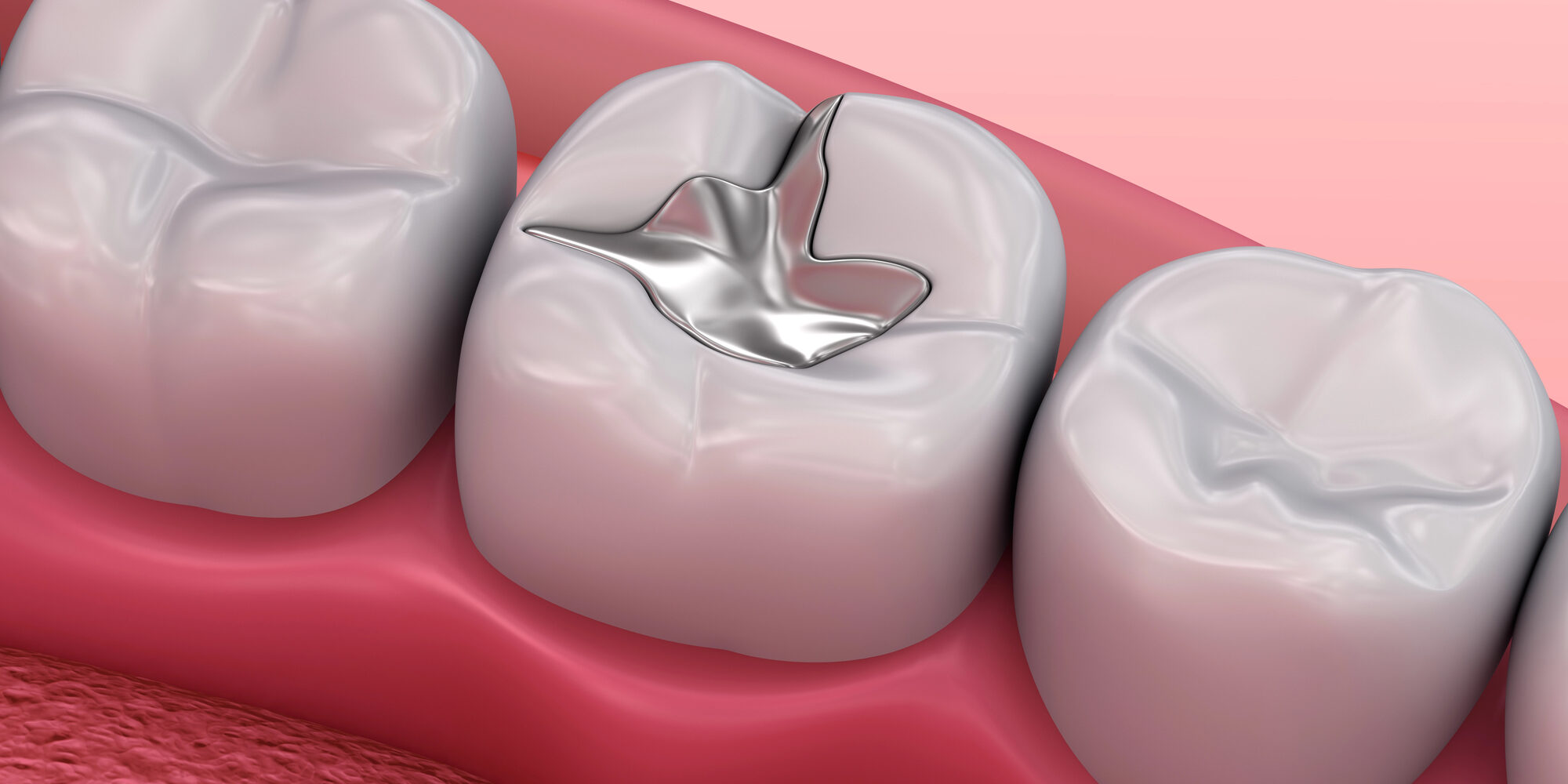 close up of silver filling