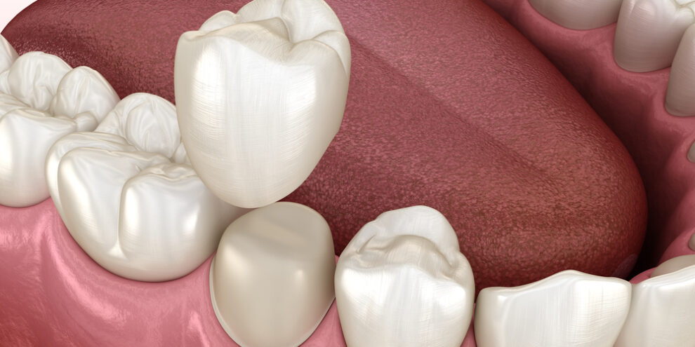 illustration of dental crown over prepped tooth