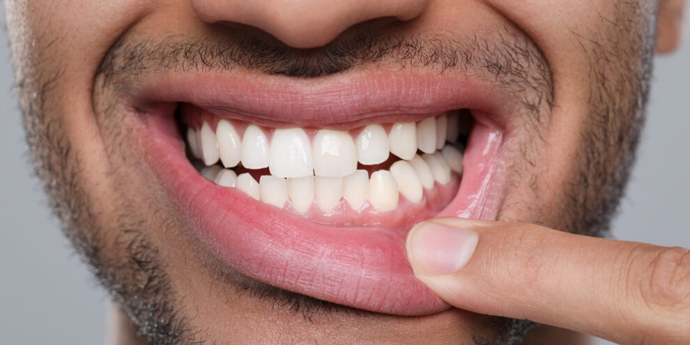 man pointing to bumps on gums