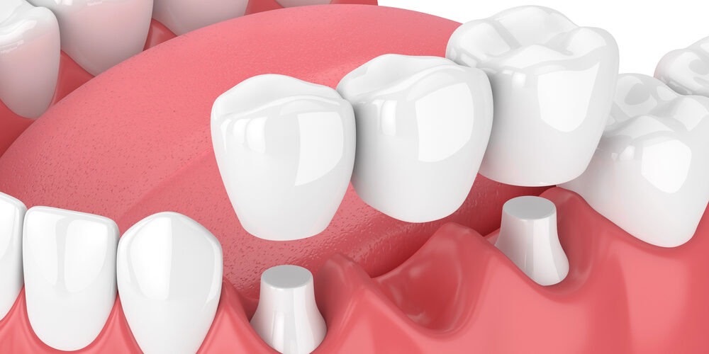 3d render of crown and bridge being placed on teeth
