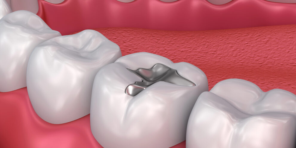 dental filling on molar