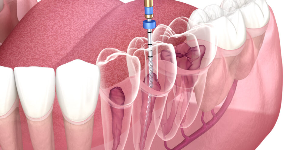 Endodontic root canal treatment process. Medically accurate tooth 3D illustration.