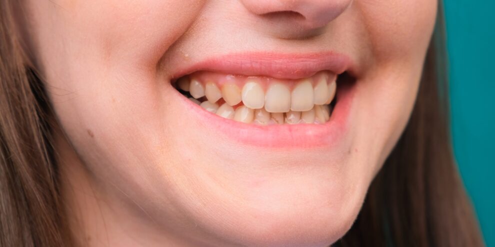 female Yellow teeth, fluorosis. Smokers problem teeth caused by fluoride, smoking, or coffee. Brown tooth enamel due to illness and medicine. Natural photo