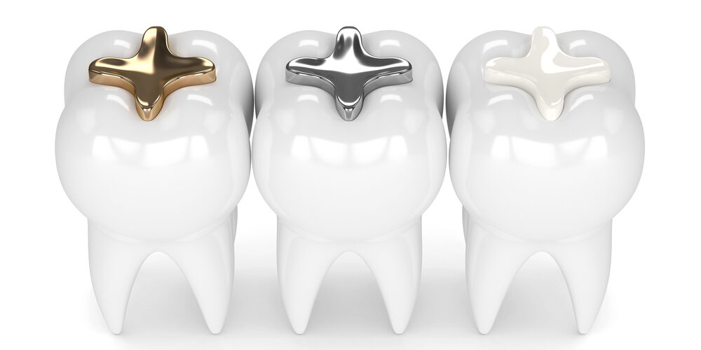 Amalgam fillings vs composite vs gold