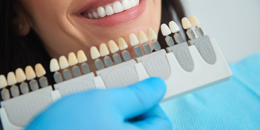 dentist holding up different shades of veneers up to woman's smile