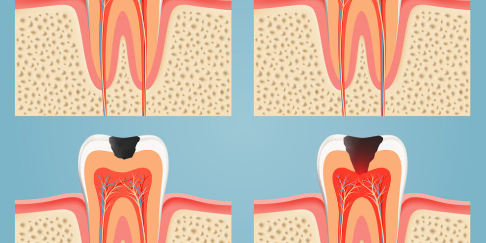 4 stages of cavities