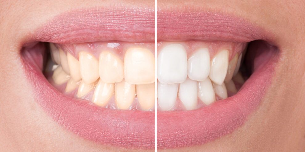 close up of woman's smile before and after teeth whitening or veneers