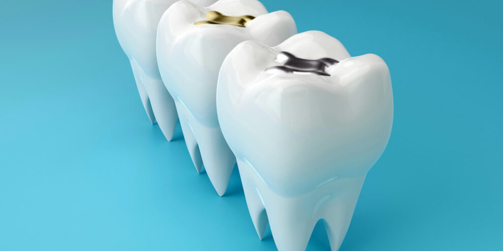 Teeth with gold, amalgam and composite inlay dental filling, perspective view. Different types of fillings, 3d render