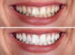 before and after teeth whitening results