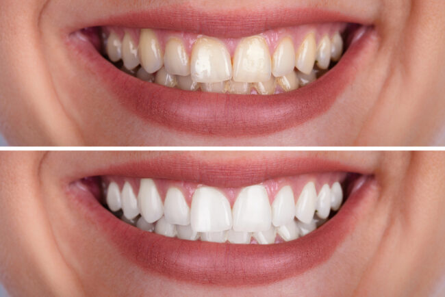 before and after teeth whitening results