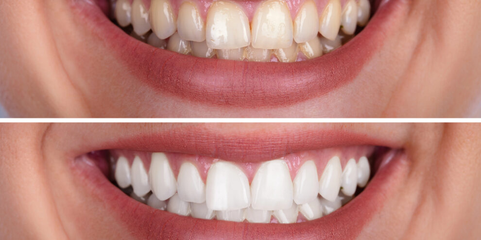 before and after teeth whitening results