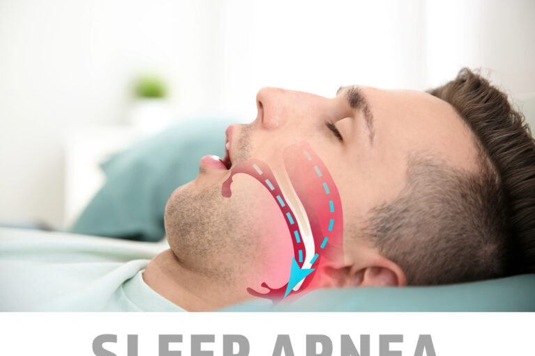 Illustration showing airway during obstructive sleep apnea