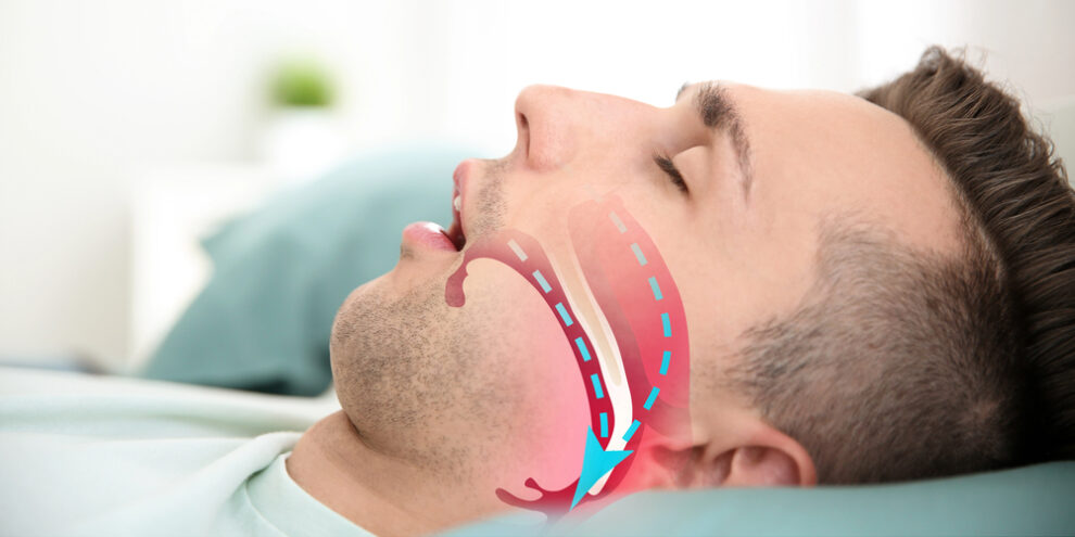 Illustration showing airway during obstructive sleep apnea