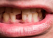 man with missing tooth