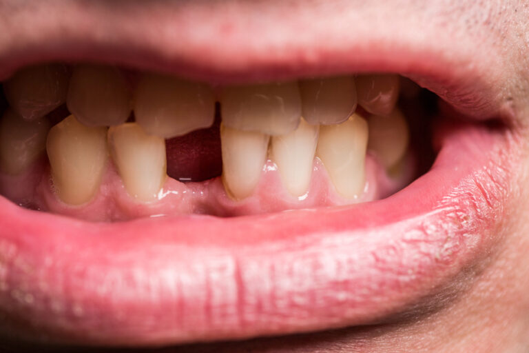 man with missing tooth
