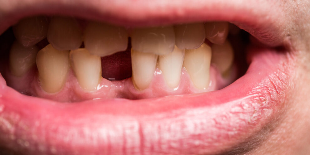 man with missing tooth