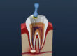 root canal treatment process