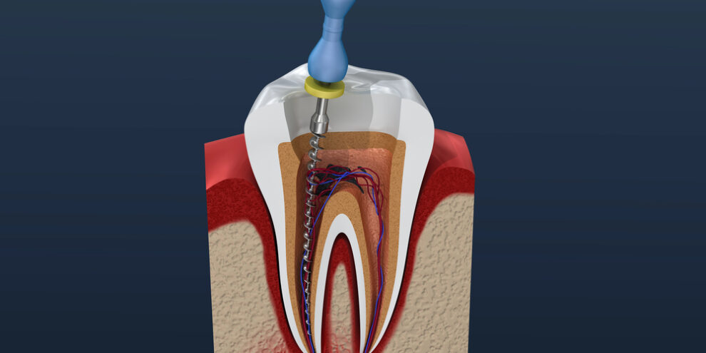 root canal treatment process